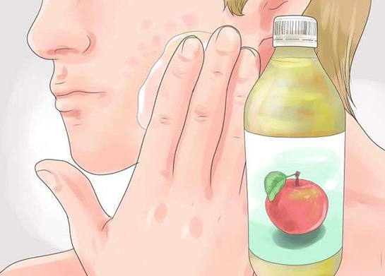 Elma Sirkesi Sivilce Lekeleri Kullanımı ve Faydaları Nelerdir?